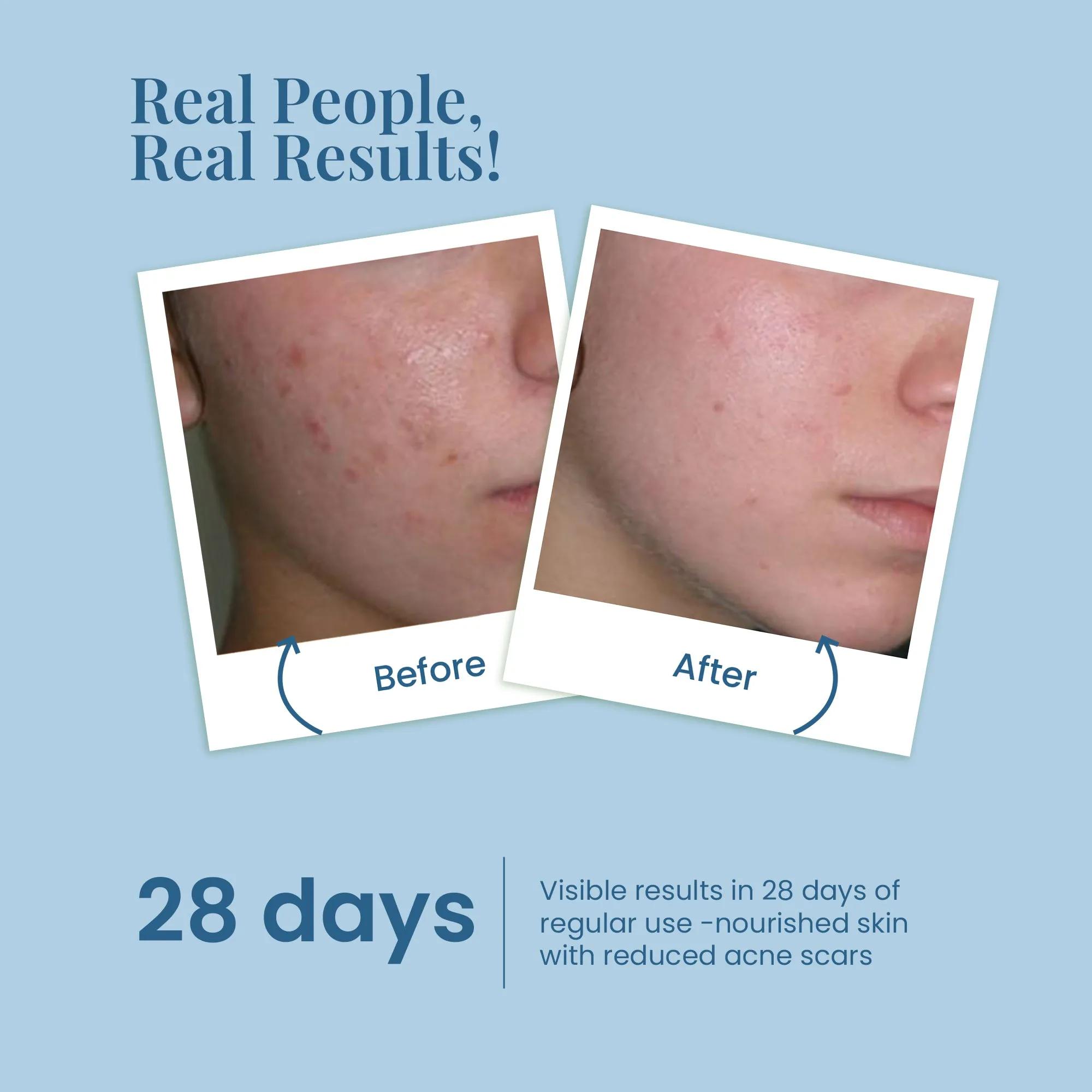 Acne & Pore Perfection Face Serum with White Haldi for Skin Radiance